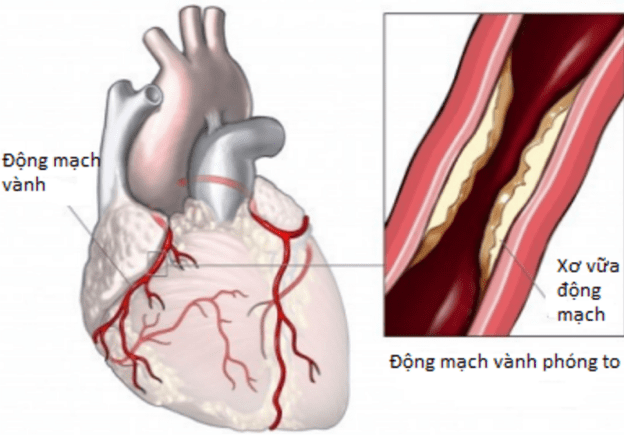 Mảng xơ vữa trên thành động mạch vành.
